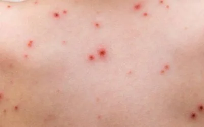 Viruela del mono ¿Es un efecto adverso?